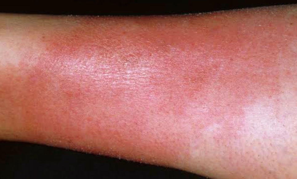 Lymphoedema